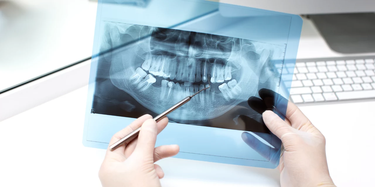 Tout Ce que Vous Devez Savoir sur les Implants Dentaires
