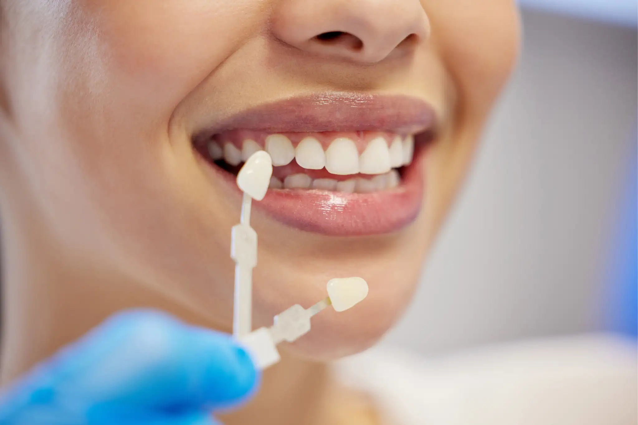 Les Facettes Dentaires : une solution éclatante pour un sourire parfait